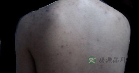 毛囊炎吃什么药好的快 毛囊炎吃什么药好的快