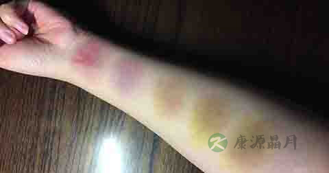 淤青用什么药散得快 淤青用什么药散得快