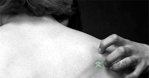 牛皮藓用什么药好