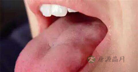 舌苔黄吃什么药效果好 舌苔黄吃什么药效果好