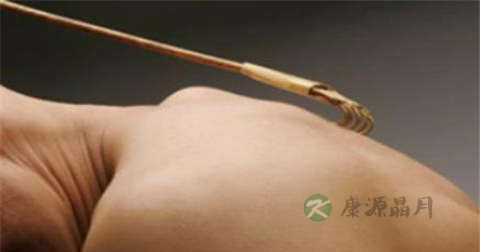 皮炎平可以用于破损处吗 皮炎平可以用于破损处吗