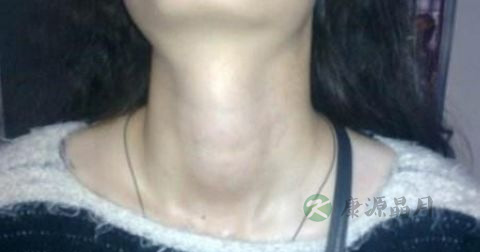 怎么治甲状腺囊肿 怎么治甲状腺囊肿