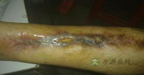 骨结核是传染病吗 骨结核是传染病吗