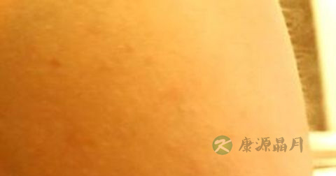 麻疹是传染病吗 麻疹是传染病吗