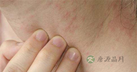 季节性皮炎可以根治吗 季节性皮炎可以根治吗