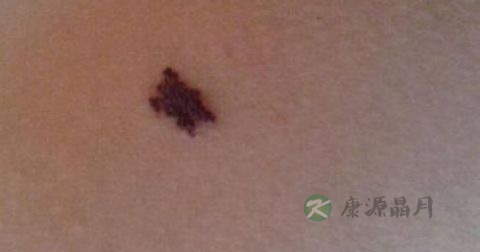 黑色素瘤如何预防 黑色素瘤如何预防