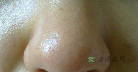 酒糟鼻增生怎么治 酒糟鼻增生怎么治