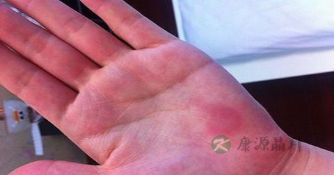 大腿肿是丹毒吗 大腿肿是丹毒吗