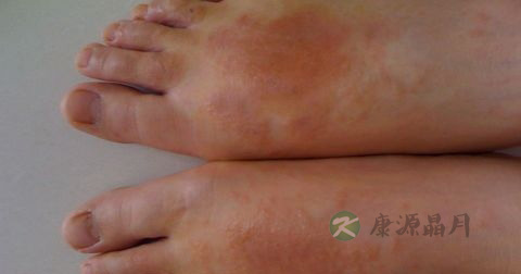 丹毒吃阿莫西林可以吗 丹毒吃阿莫西林可以吗