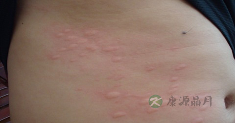 得了麻疹怎么治 得了麻疹怎么治