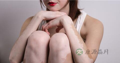 如何诊断白癜风 如何诊断白癜风