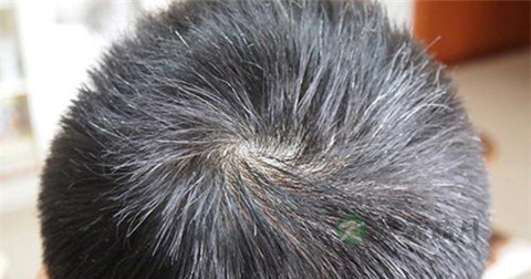 毛囊炎扩散吗 毛囊炎扩散吗