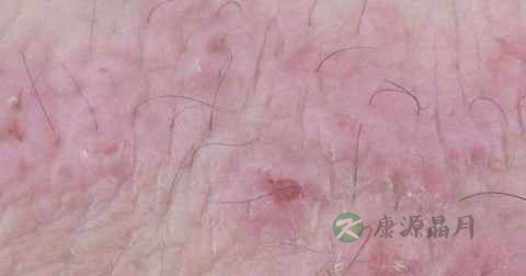 女人性病能治好吗 女人性病能治好吗