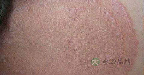 体股癣怎么治 体股癣怎么治