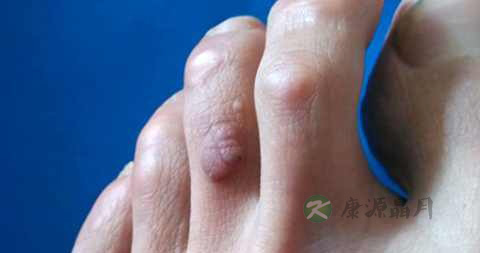 瘊子刚开始长什么样 瘊子刚开始长什么样