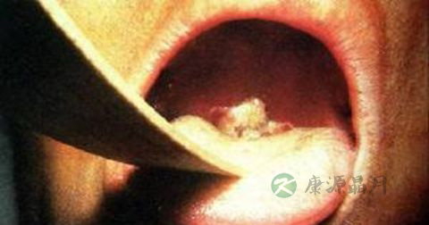 白喉是传染病吗 白喉是传染病吗