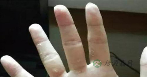 雷诺病怎么治 雷诺病怎么治