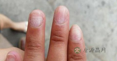 灰指甲是传染病吗 灰指甲是传染病吗