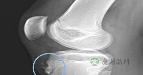 膝关节骨膜受损怎么治 膝关节骨膜受损怎么治