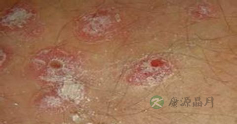 阴虱病的传染途径 阴虱病的传染途径
