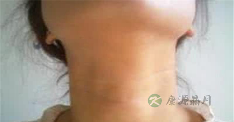 如何预防甲状腺疾病 如何预防甲状腺疾病