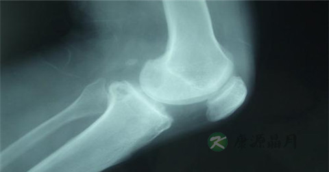 骨折接骨后吃什么好 骨折接骨后吃什么好