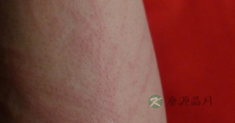 皮炎忌口什么 皮炎忌口什么