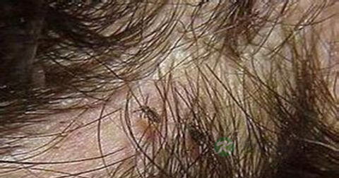 阴虱病的病因 阴虱病的病因