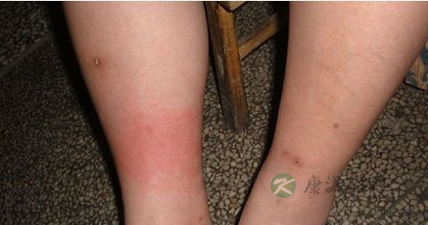 大腿肿是丹毒吗 大腿肿是丹毒吗