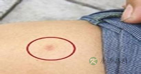 艾滋病如何预防控制 艾滋病如何预防控制