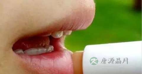 嘴角疮怎么治 嘴角疮怎么治