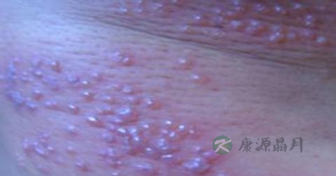 带状疱疹是传染病吗 带状疱疹是传染病吗