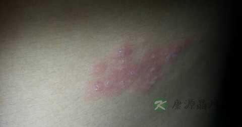 如何预防带状疱疹 如何预防带状疱疹