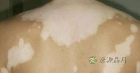 白癜风吃什么好 白癜风吃什么好