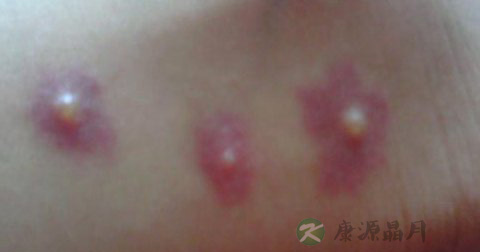 水痘的危害性 水痘的危害性