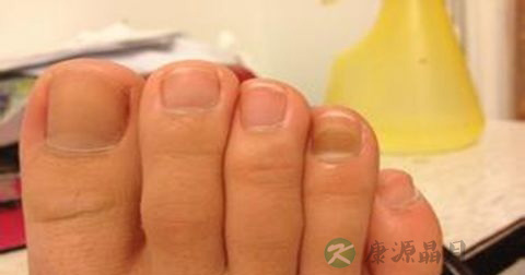 灰指甲是传染病吗 灰指甲是传染病吗