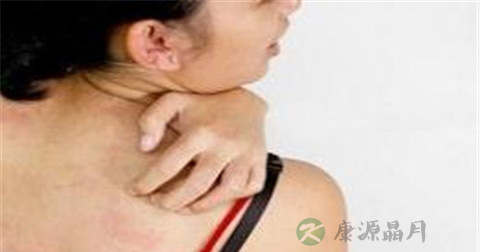 荨麻疹常见病因 荨麻疹常见病因