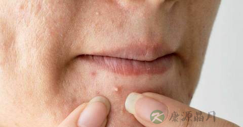 酒糟鼻增生怎么治 酒糟鼻增生怎么治