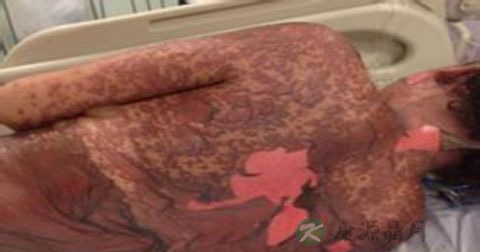 药物过敏的急救措施 药物过敏的急救措施