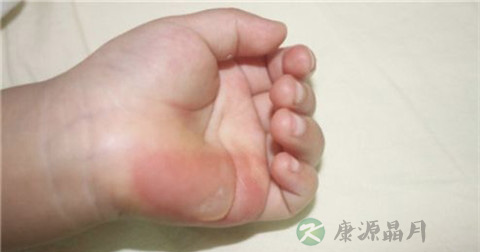 烫伤后起水泡怎么止痛 烫伤后起水泡怎么止痛