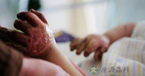 烧伤如何急救 烧伤如何急救