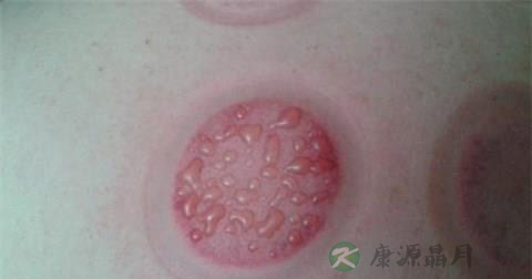 拔罐起水泡怎么回事 怎么办好 拔罐起水泡怎么回事 怎么办好
