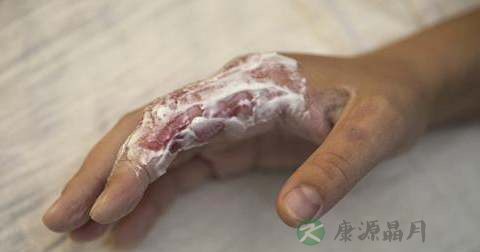 脸和手被鞭炮炸伤怎么办 脸和手被鞭炮炸伤怎么办