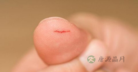 被玻璃划出血如何处理 被玻璃划出血如何处理