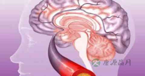 脑血栓的急救方法 脑血栓的急救方法