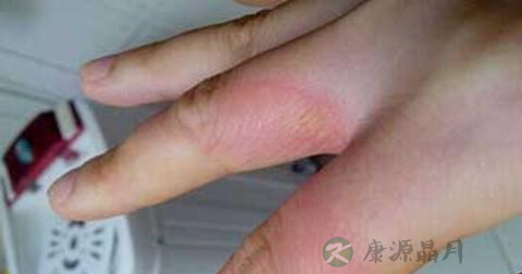 宝宝烫伤用什么消毒 宝宝烫伤用什么消毒