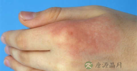 新生儿烫伤起泡怎么办 新生儿烫伤起泡怎么办