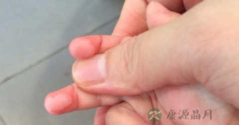 被热水烫伤怎么办 被热水烫伤怎么办