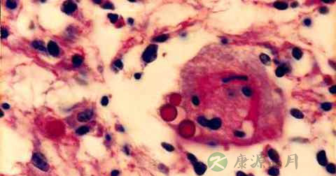 隐球菌病由什么传播 隐球菌病由什么传播