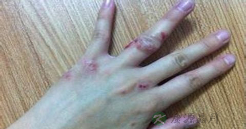 真菌感染用什么药 真菌感染用什么药